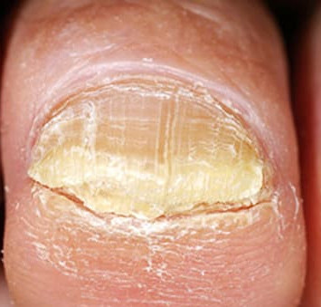 Toenail fungus