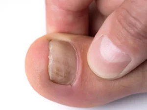 Nail Psoriasis vs. Fungus